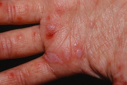 Phân biệt nốt phát ban tay chân miệng với bệnh khác