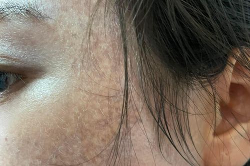 Mặt cháy đen vì lăn kim, lột da bằng hóa chất vô tội vạ