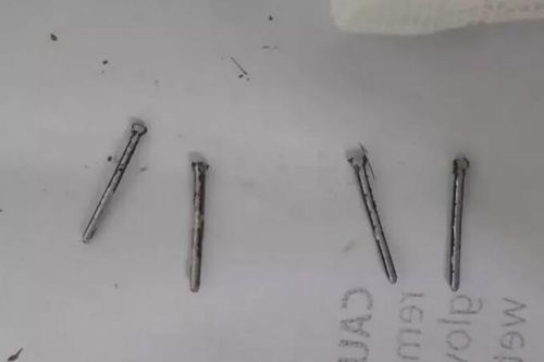 Buồn chuyện gia đình, tự bắn 4 cây đinh vào đầu