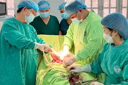 Cứu thai phụ chửa ngoài tử cung vỡ khi thai 28 tuần