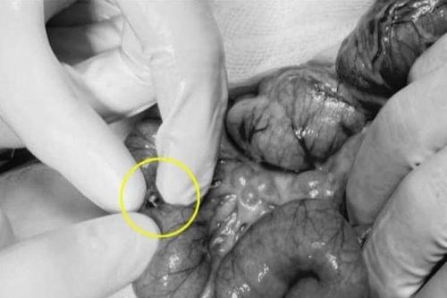 Thêm bé gái 3 tuổi thủng ruột vì món đồ chơi quen thuộc