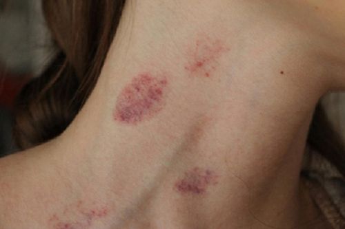 Cô gái 23 tuổi đột ngột qua đời sau khi hôn bạn trai