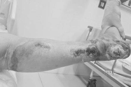 Bị hoại tử, phải cắt cụt chân do mắc đái tháo đường nhưng không điều trị