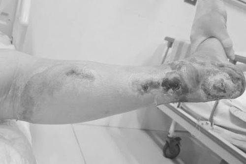 Bị cắt cụt chi vì không điều trị đái tháo đường