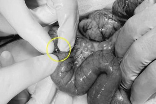 Bé 3 tuổi thủng ruột vì món đồ chơi quen thuộc