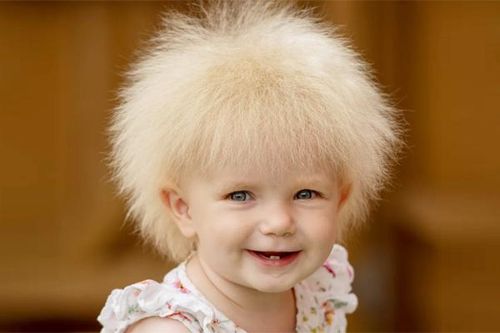 Em bé mắc hội chứng lạ có mái tóc khiến nhiều người thích thú
