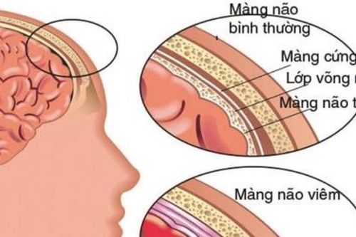 Bệnh viêm màng não ở trẻ em rất nguy hiểm, có thể dẫn đến tử vong