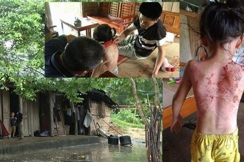 Hoàn cảnh đáng thương của gia đình cháu bé bị hàng xóm dội nước sôi vào người