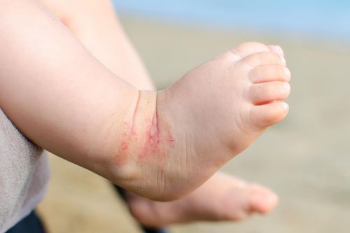 Căn bệnh có thể gây viêm nhiễm da trẻ trong mùa hè
