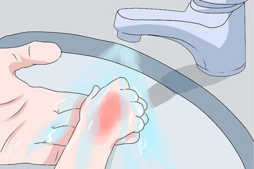 Trẻ nguy kịch do chữa bỏng sai: Bác sĩ gợi ý cách sơ cứu chuẩn nhất