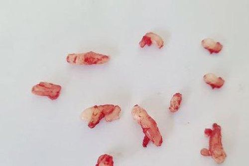 Người có 10 chiếc răng ngầm