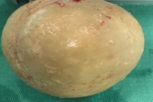 Viên sỏi trong bàng quang nặng 400g