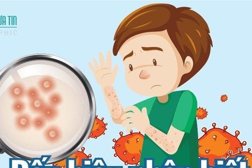 Info: Dấu hiệu nhận biết bệnh đậu mùa khỉ