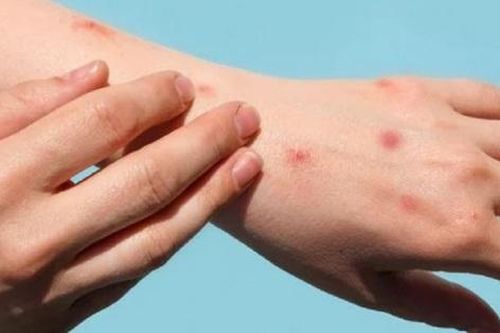 3 khuyến cáo để hạn chế nguy cơ mắc đậu mùa khỉ