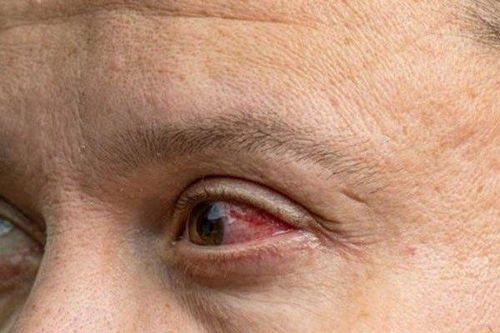Căn bệnh khiến người mắc khóc ra máu, tỉ lệ tử vong đến 40%