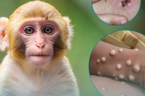 Bộ Y tế hướng dẫn cách điều trị, phòng bệnh đậu mùa khỉ