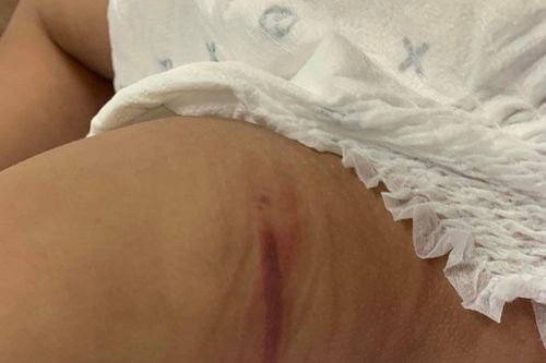 Tình hình sức khỏe của cháu bé 18 tháng tuổi bị bạo hành