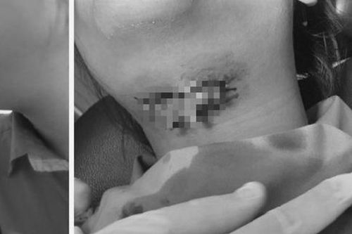 Lệch mặt vì chọc tăm vào vết sưng răng khôn 'mọc dại'