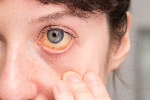 9 triệu chứng của người bệnh viêm gan B