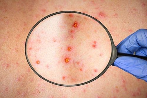 5 câu hỏi thường gặp về bệnh đậu mùa khỉ