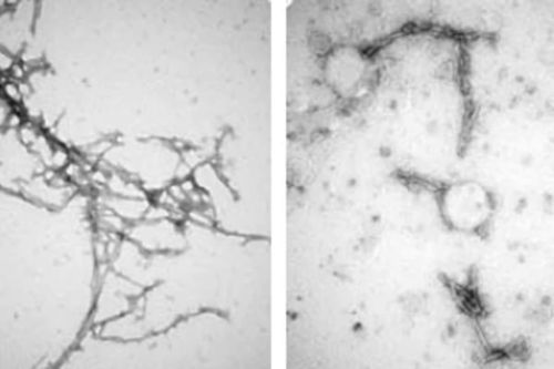Phương pháp 'ngăn' Parkinson bằng công nghệ nano