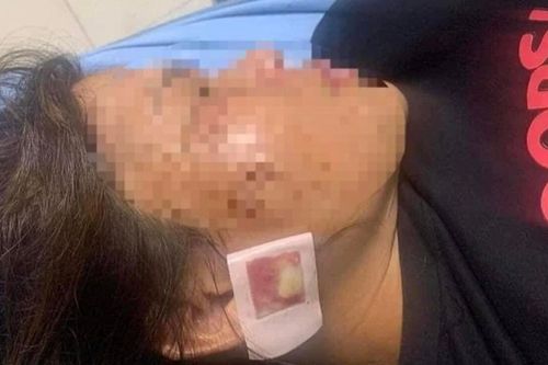 Xác minh việc người phụ nữ bị thương nghi do súng nổ