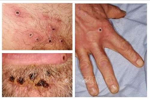 Bỉ cảnh báo những biểu hiện không điển hình của bệnh đậu mùa khỉ