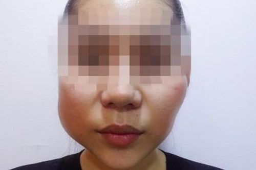 Theo trend 'tiêm filler trẻ hóa' dù mới 24 tuổi, cô gái miền Tây bị áp xe hoại tử mặt