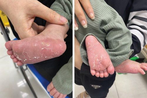 Bé trai 46 ngày tuổi mắc bệnh giang mai bẩm sinh