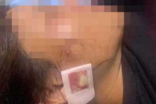 Thanh Hóa: Xác minh thông tin người phụ nữ bị thương nghi do súng bắn