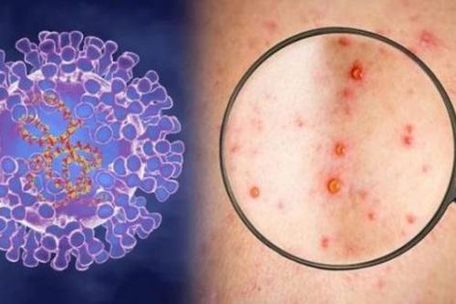 Bộ Y tế: Tăng cường phòng chống bệnh Đậu mùa khỉ