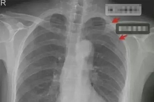 Bị nam đồng nghiệp ôm quá mạnh, cô gái gãy 3 xương sườn