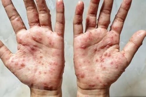 Mỹ tuyên bố đậu mùa khỉ là tình trạng khẩn cấp về sức khỏe cộng đồng