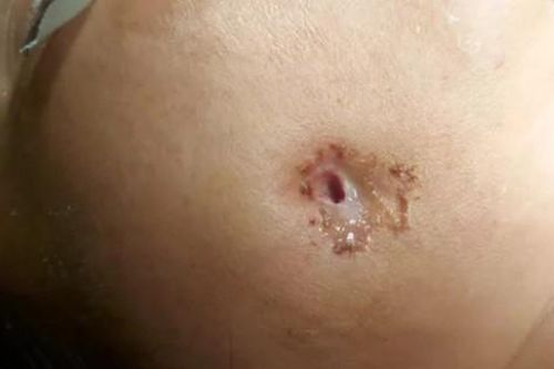 Hy hữu: Răng khôn mọc lệch đâm thủng má vẫn nghĩ là... mụn