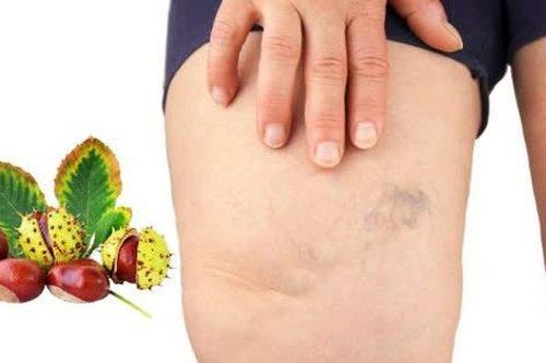 Tác dụng của hạt dẻ ngựa với chứng giãn tĩnh mạch chân