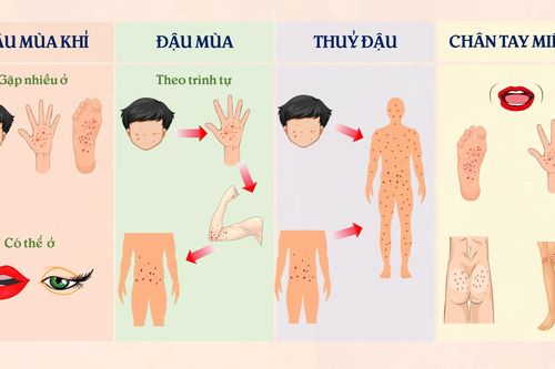 Phân biệt triệu chứng các bệnh đậu mùa khỉ, tay chân miệng và thủy đậu