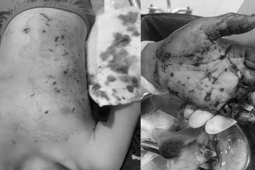 Hàng trăm mảnh bóng đèn vỡ bắn vào người bé 10 tuổi