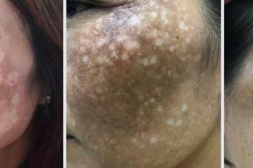 Mặt loang lổ như pháo hoa vì đắp 'thần dược' trị nám