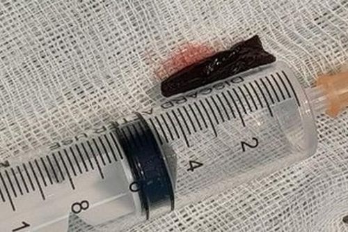 Lấy mảnh gỗ dài 3cm nằm trong cổ bệnh nhân suốt... 4 tháng