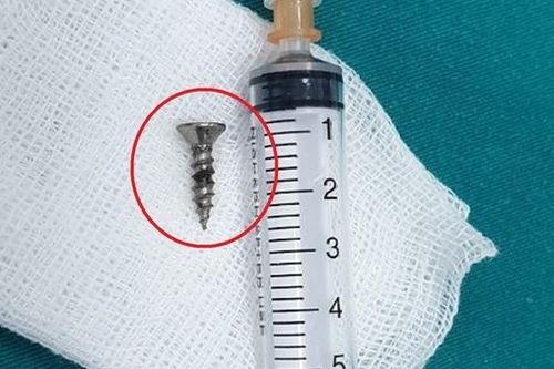Kịp thời cứu cháu bé 22 tháng tuổi bị đinh vít 1,5cm găm vào phế quản