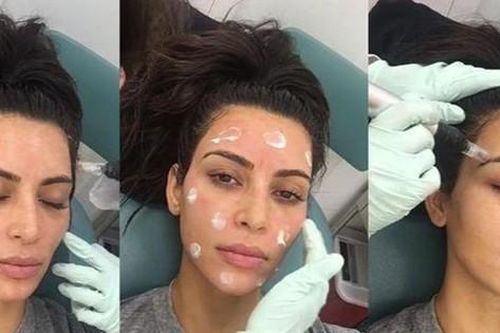 4 phương pháp làm đẹp đau đớn của Kim Kardashian: 'Mặt nạ ma cà rồng' gây khiếp sợ
