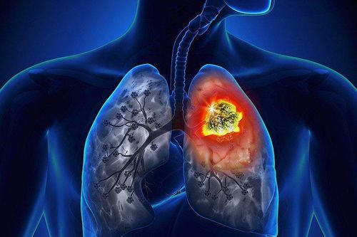 Khiến 1,8 triệu người tử vong hằng năm, ai dễ mắc loại ung thư này?