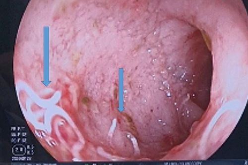 Bé 3 tháng tuổi xuất huyết tiêu hóa nghi do bú sữa pha nước sông