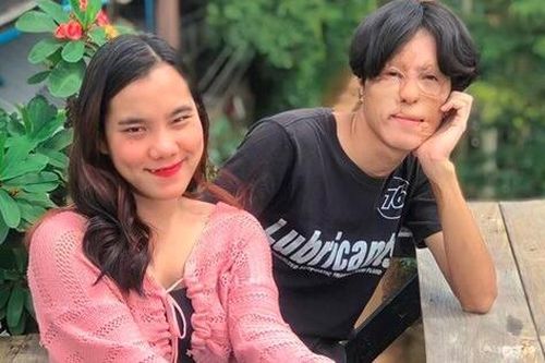 'Tình yêu cổ tích' của chàng trai có gương mặt biến dạng