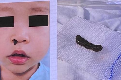 Hi hữu: Vắt làm tổ trong mũi bé trai, miếng sắt găm sâu trong hốc mắt thợ cơ khí