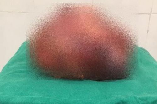 Phẫu thuật thành công khối u tuyến thượng thận nặng 3,5 kg