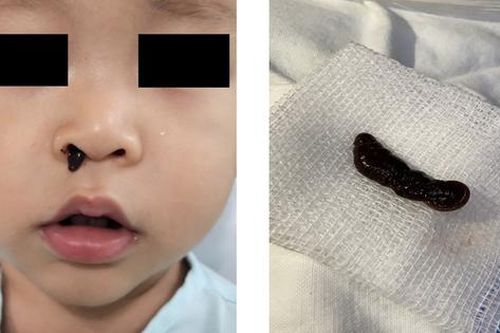 Đi tắm suối, bé trai 18 tháng tuổi bị vắt chui vào mũi