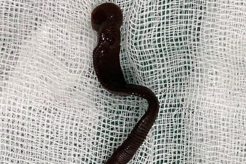 Gắp con đỉa dài 8cm sống trong khí quản bệnh nhi suốt 1 tháng