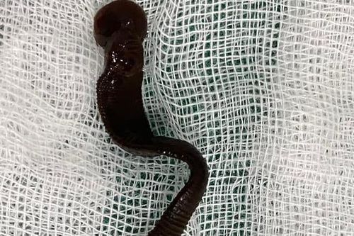 Đỉa dài 8cm sống trong khí quản cậu bé 15 tuổi suốt 1 tháng