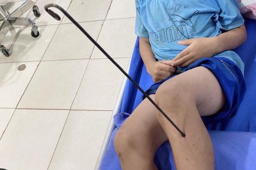 Hà Giang: Bé trai 9 tuổi bị mũi tên tự chế dài 60cm cắm sâu ở chân
